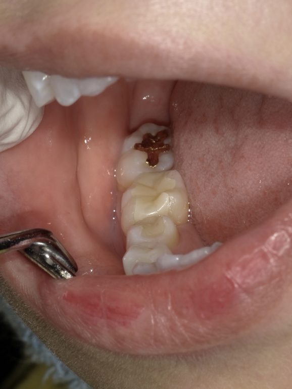 セラミック治療（ジルコニアインレー） 