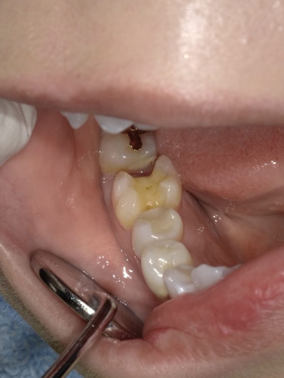 セラミック治療（ジルコニアインレー） 