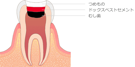 歯の神経を取らない治療