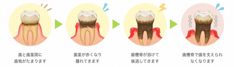 歯周病とは